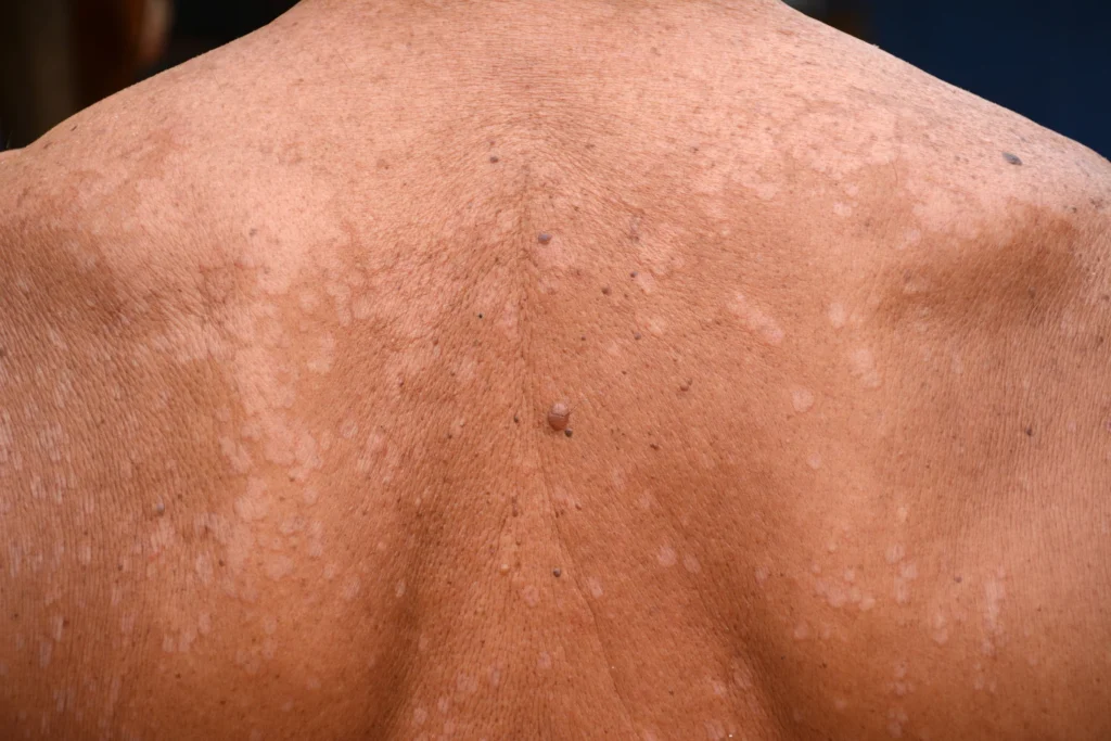 How to Stop Tinea Versicolor Naturally: Secrets to Healthy Skin top 8 home remedies for tinea versicolor treatment
